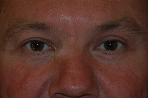 Blepharoplasty 6b